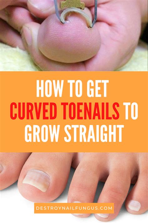 How To Get Toenails To Grow Straight The Complete Guide