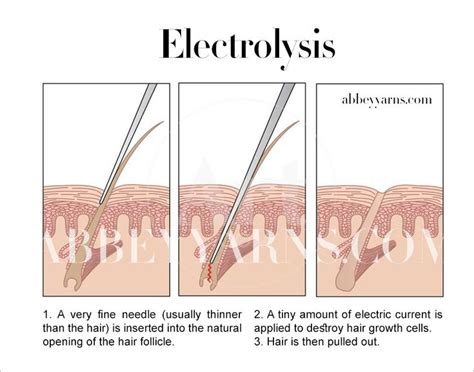 Hair removal is permanent except for a woman's facial hair. Electrolysis vs. Laser Hair Removal: The Complete Guide ...