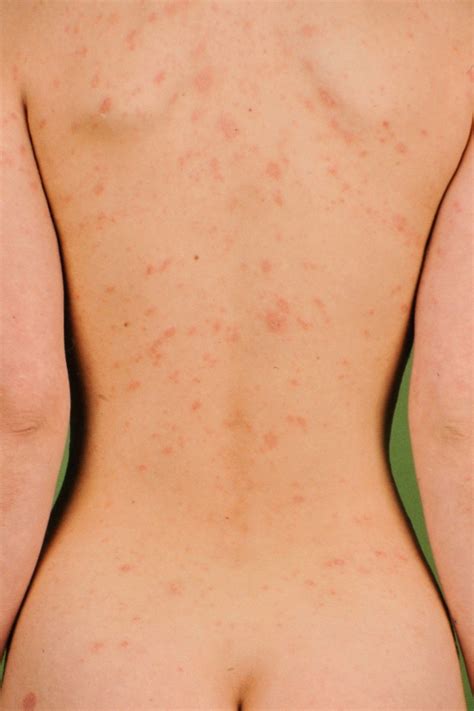 Pityriasis rosea is associated with reactivation of herpesviruses 6 and 7, which cause the primary rash roseola in infants. Pityriasis rosea (patientenfolder)