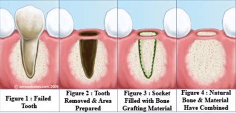 Tooth Extractions Srq Dentistry Sarasota Dentist