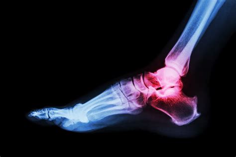 What Does Arthritis In The Ankle Feel Like Footsurgeon