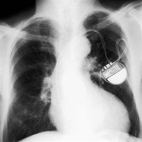 What Is A Dual Chamber Pacemaker With Pictures