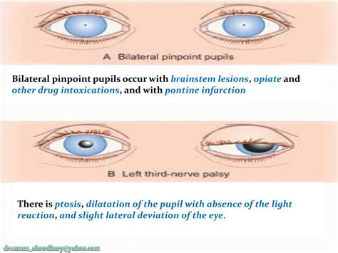 Pinpoint Pupils Head Injury Lomiplanet