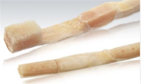 Bone Tendon Bone Allograft Acl Reconstruction Queensland Lower Limb