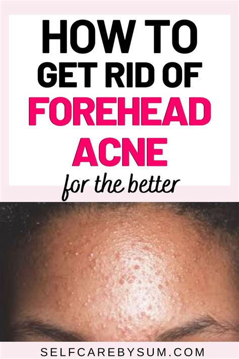 How To Get Rid Of Forehead Acne Sbs Forehead Acne Forehead Bumps