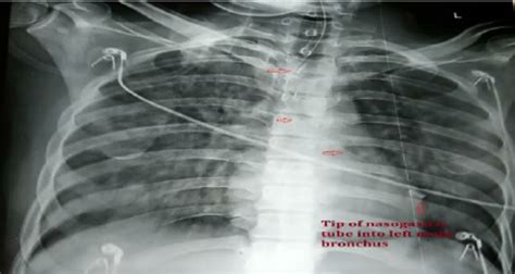 Chest X Ray Pa View Showing Path Of Nasogastric Tube Horizontal