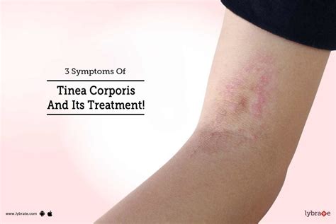 3 Symptoms Of Tinea Corporis And Its Treatment By Dr Sunil Menon