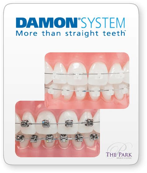 Damon Braces Derby Crooked Teeth Straightening Park Brace Clinic Orthodontist Near Me