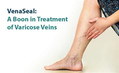 Kmch Vein Clinic Becomes First In Covai To Introduce ‘venaseal