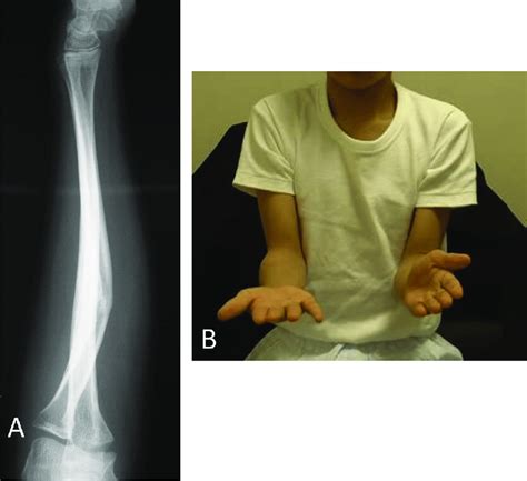 13 Year Old Boy Presented With Dorsally Angulated Malunion Of The Left