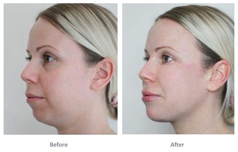 Sculpting Slimming Your Jawline With Chin Dermal Fillers Get A