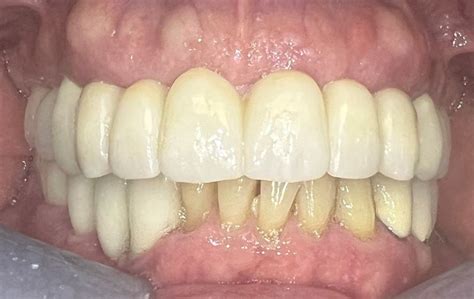 Dental Case Study 40 North Shore Restorative And Implant Dentistry