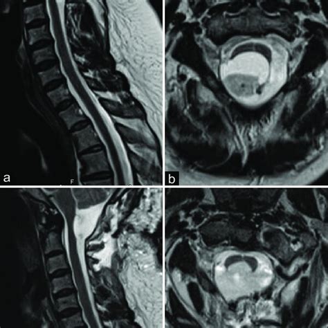 Preoperative Sagittal Cervical Magnetic Resonance Imaging MRI Download Scientific Diagram
