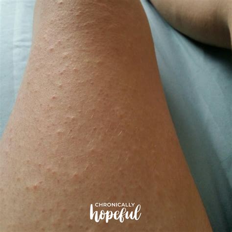 Rashes And Hives On My Legs By Chronically Hopeful Chronically Hopeful