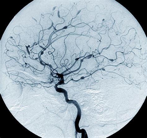 Cerebral Aneurysms In Lupus Photograph By Zephyrscience Photo Library