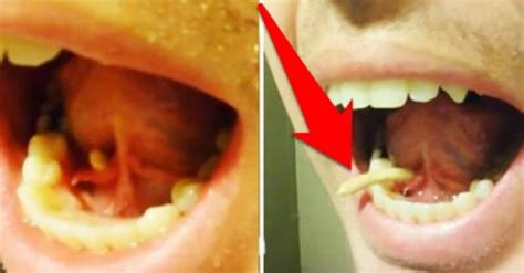 Man Squeezes Out Giant Salivary Gland Stone From Under His Tongue