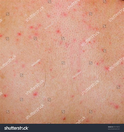 Allergic Rash Dermatitis Back Skin Of Patient Stock Photo 79173973