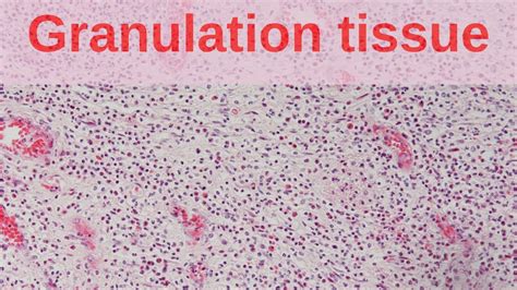 What Is Granulation Tissue Pathology Mini Tutorial Youtube