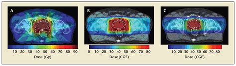 Proton Beam Therapy For Localized Prostate Cancer Basics Controversies And Facts