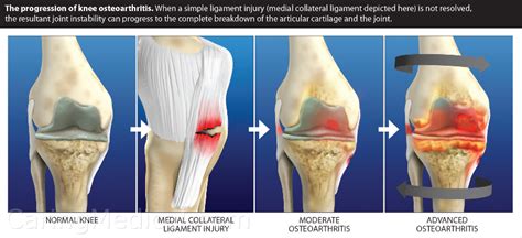 Treating Knee Osteoarthritis In The Aging Athlete
