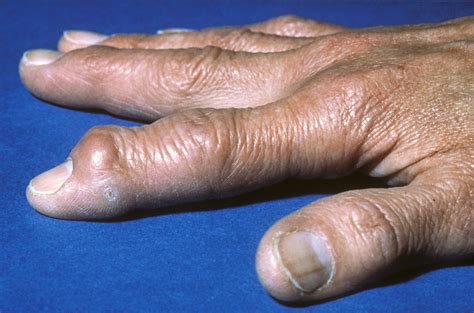 Comorbid Hand Oa Ra Associated With Greater Pain Rheumatology Advisor