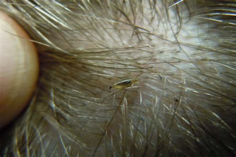Head Lice Facts Nit Enz Ends Nits