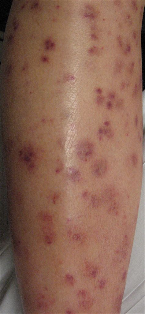 Leukemia Symptoms Skin