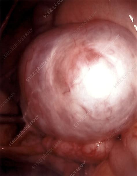 Dermoid Ovarian Cyst Endoscope View Stock Image M8500638