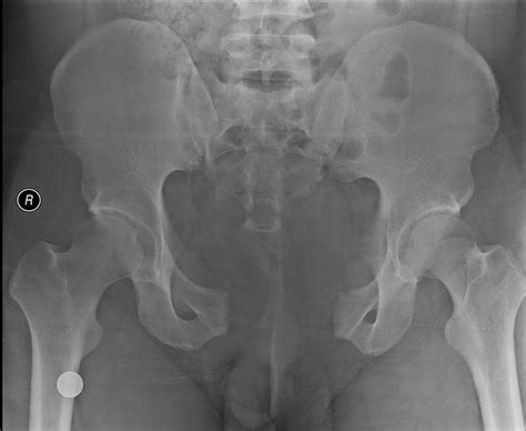 Open Book Fracture Of The Pelvis Radiology Imaging Radiology Pelvis
