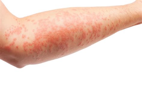 Psoriasis Vs Eczema The Biggest Difference Is Usually Age
