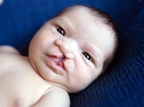 Cleft Lip And Palate In Babies Photos Babycenter India