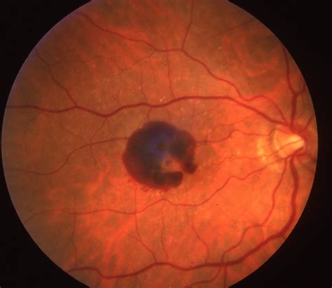 Maybe you would like to learn more about one of these? What are the treatment options for Macular Degeneration or ...
