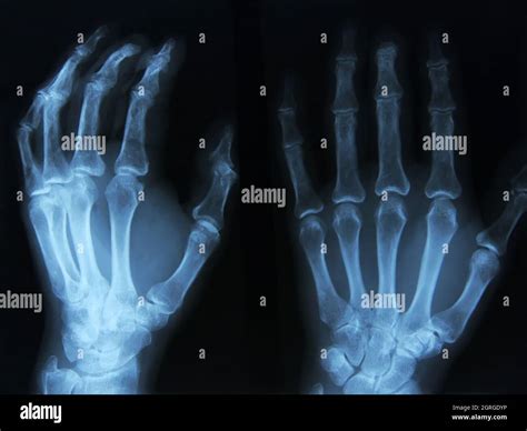 X Ray Of Human Left Hand Stock Photo Alamy