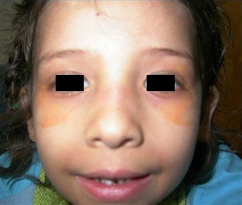 Yellow Eyelids Xanthelasma High Resolution Pictures And