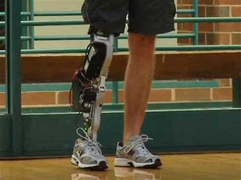 Smart Lower Limb Prosthetic Enables Amputees To Walk With Less Effort