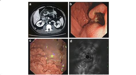 Ct Endoscopy And Ultrasonography Examination A Abdominal Ct Shows A