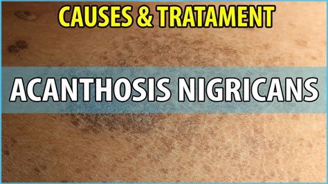What Is Acanthosis Nigricans Causes Symptoms And Treatments Youtube