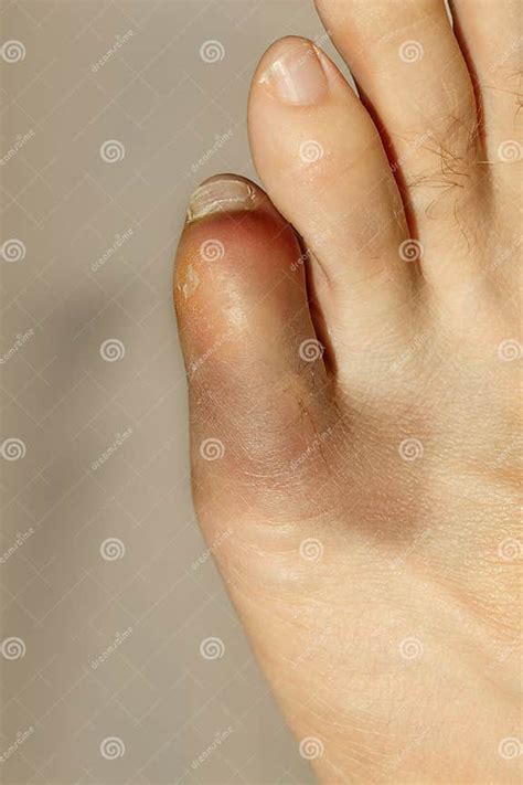 Little Toe With Severe Inflammation And Bruising Stock Photo Image Of