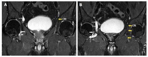 Cystic Lesions Of Peripheral Nerves Are We Missing The Diagnosis Of