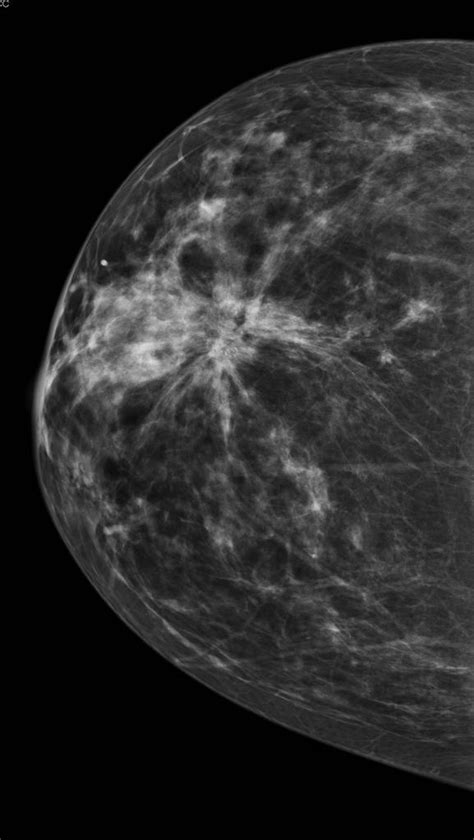 Mammography Wikidoc