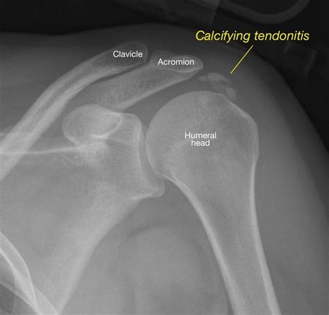 석회성 건염 calcified tendonitis xray sono 네이버 블로그