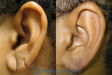 Torn Ear Lobe Before And After Photo Gallery Washington Dc Potomac Plastic Surgery