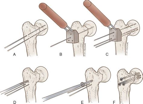 11 Orthopedic Surgery Basicmedical Key