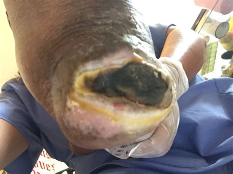 The term eschar is not interchangeable with scab. ENLUXTRA for Any Wound BLOG - ENLUXTRA