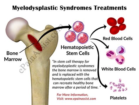 Myelodysplastic Syndromes Treatmentschemotherapyimmunotherapybone