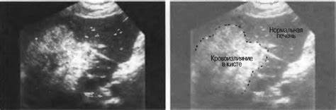 Киста в печени диета лечение Киста В Печени На Узи Фото — Фото Картинки Киста В Печени На Узи Фото — Фото Картинки Киста в печени диета лечение