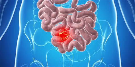 Bowel Cancer Colon Cancer Causes Symptoms Diagnosis