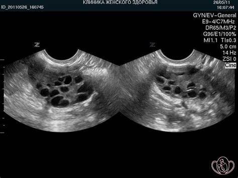 Диета киста яичника Киста Яичника На Узи Фото У Женщин — Картинки фотографии Киста Яичника На Узи Фото У Женщин — Картинки фотографии Диета киста яичника