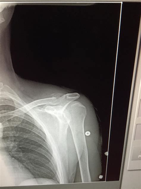 Clavicle Shaft Fractures Trauma Orthobullets