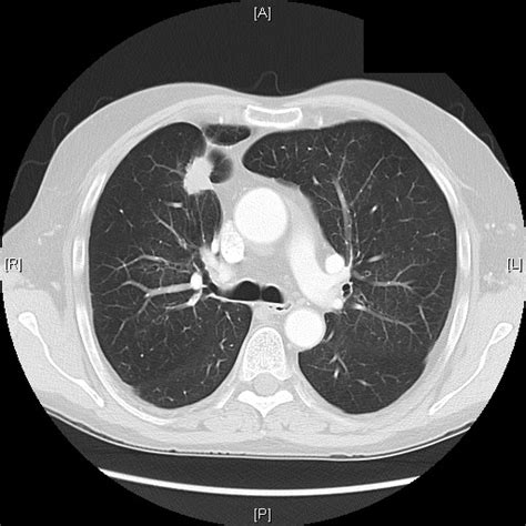 Ct Scan Chest Lesion In The Right Lung Download Scientific Diagram